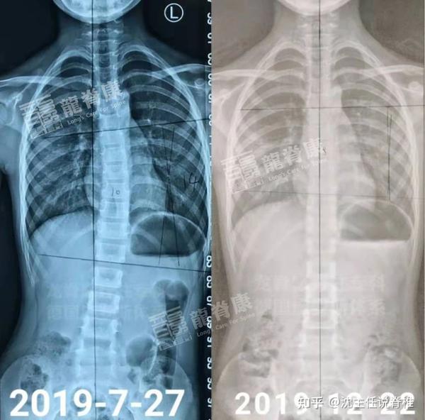 存在高低肩,拍站立位x光片后发现患有轻度脊柱侧弯,cobb角14°,从2019