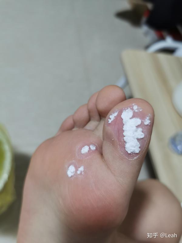 阿司匹林治跖疣有图慎入