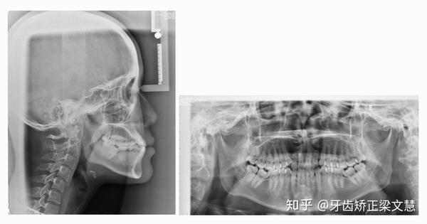 正畸检查的拍片都检查的是什么呢