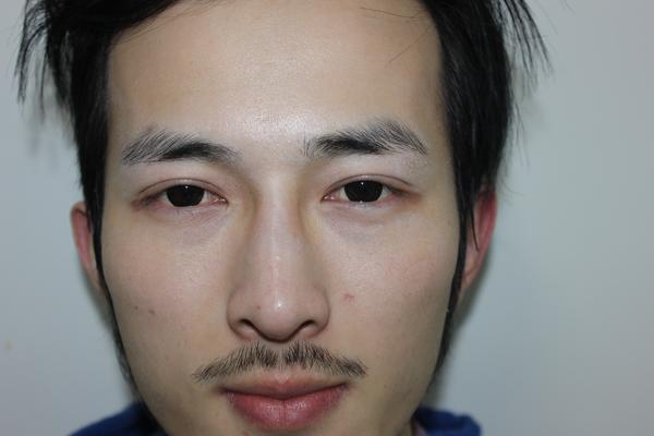 男生做双眼皮手术是什么体验?