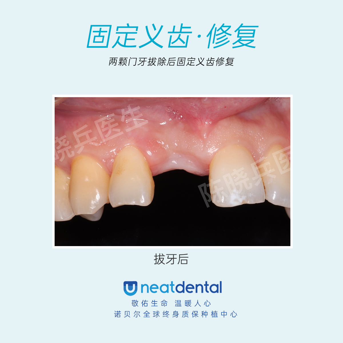广州种植牙缺失牙修复种牙一定是最好的吗