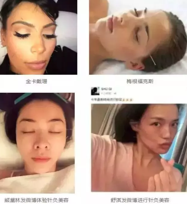 汇美丽|原来中国的【针灸美容】在国外这么火,明星也是它的忠实粉丝!