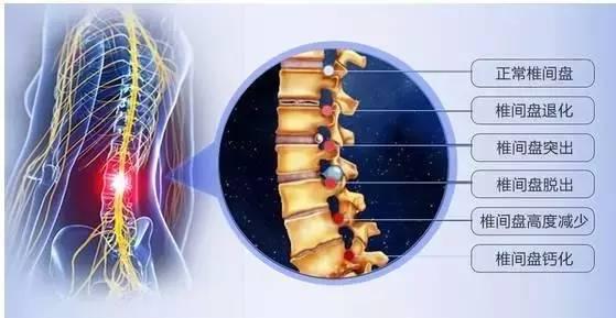 引起腰间盘突出的7种因素,一般人我不告诉他!网友:后悔才知道