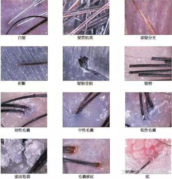 植多少毛囊单位?先做毛囊检测