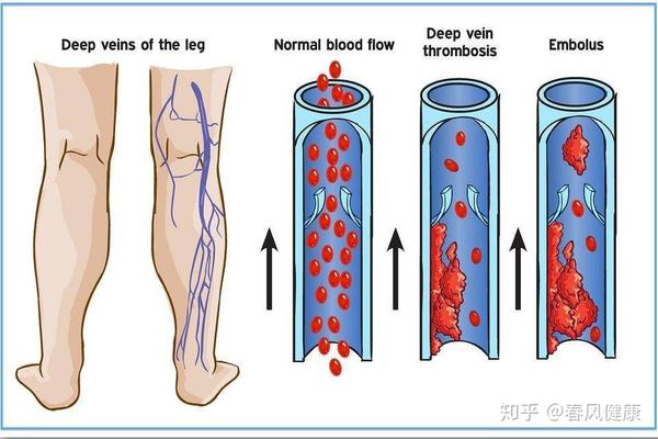 胃癌术后预防下肢深静脉血栓