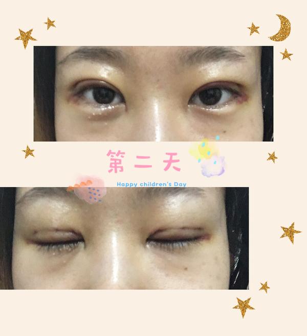 全割好还是韩式三点双眼皮好?