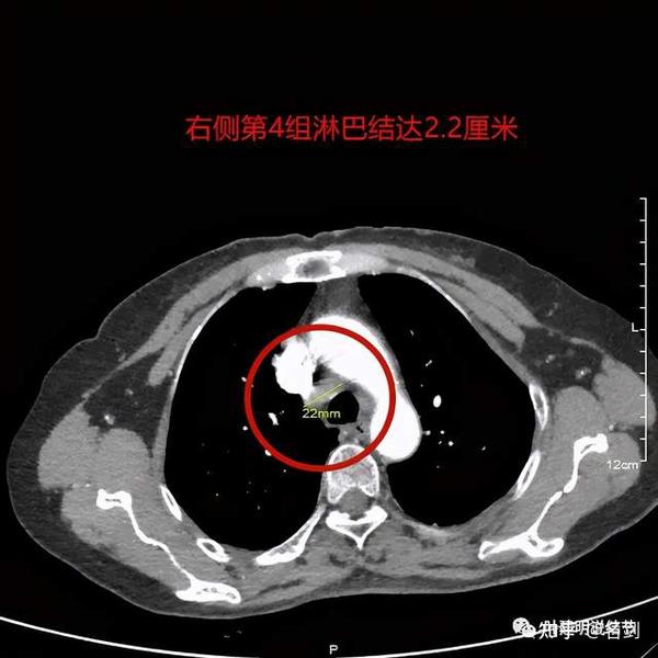 右侧第4组淋巴结达2.2厘米