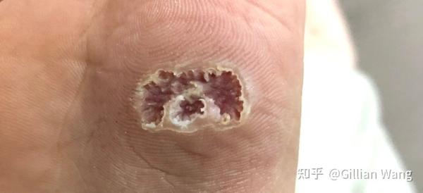 奋战了半年的跖疣终于痊愈了没有冷冻单靠药膏哦