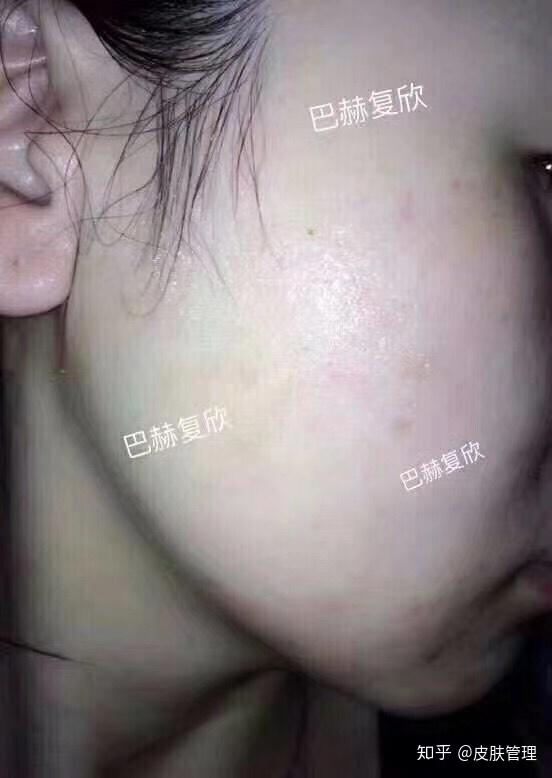 巴赫复欣使用效果