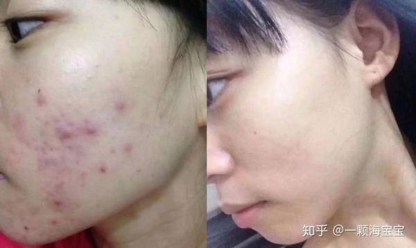 祛痘少走弯路,痘痘痘印再也不见