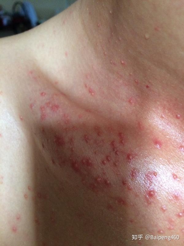 怎么根治糠秕孢子菌毛囊炎