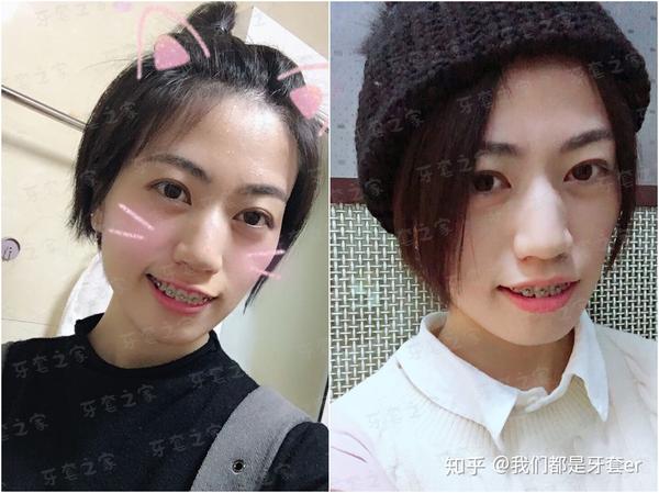 案例分享 | 骨性龅牙,986天结束牙套,现在跟人家讲话