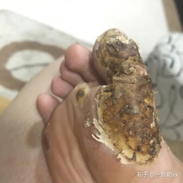 漫漫跖疣之路,lyx治愈我1