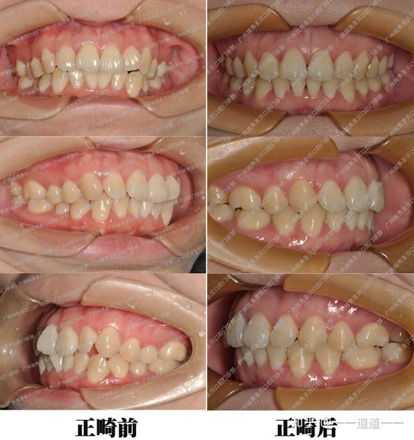 广州圣贝口腔牙齿矫正案例分享一