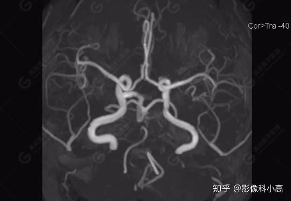 少见血管变异——永存三叉动脉3例