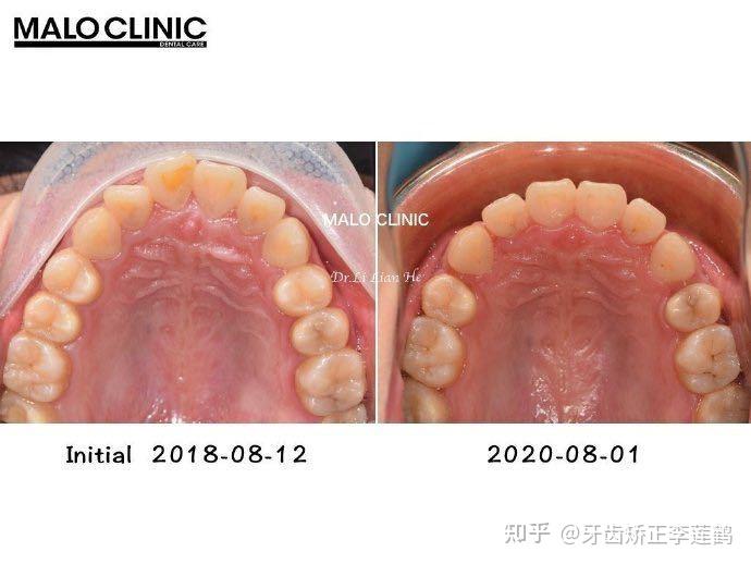 北京牙齿矫正丨骨壁薄患者易发生骨开窗,做好规避风险