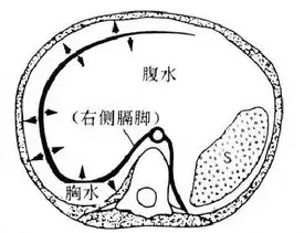 晚期肺癌患者的胸水,腹水是什么,该怎么应对?