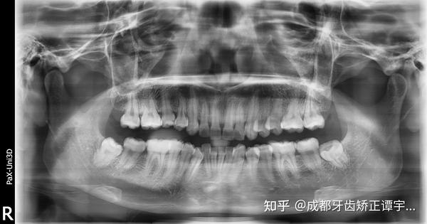 我们所说的拍牙片,一般是指口腔内全景片,头颅侧位片和牙齿ct,它们