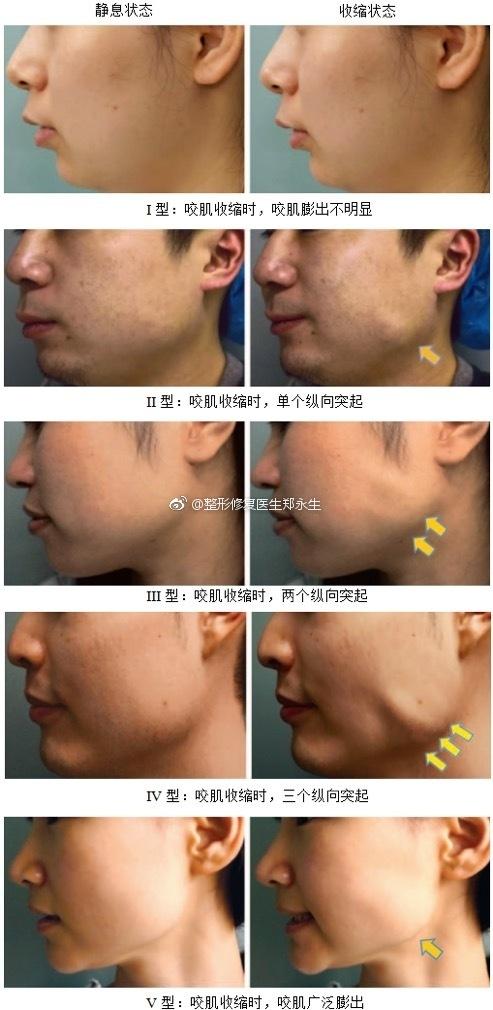67自测一下你的咬肌是哪一型