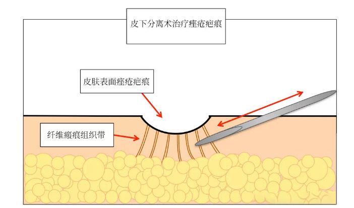 干货分享关于皮下剥离皮下分离的那些冷知识