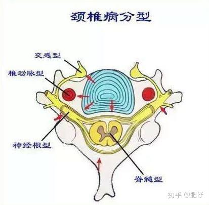 神经根型颈椎病就是出现了根型症状,常表现为脊神经支配区域出现麻木