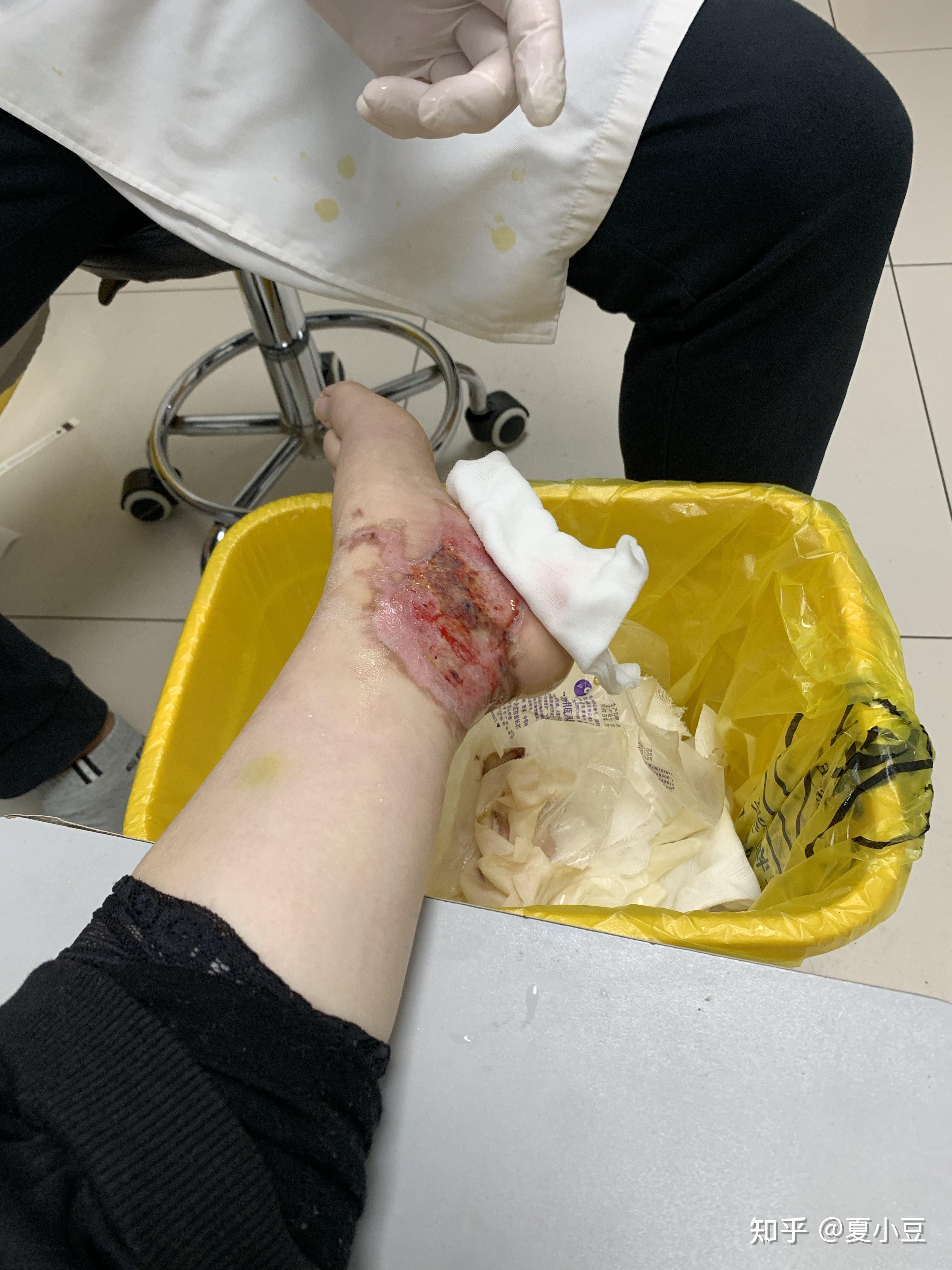 浅二度深二度烫伤过程