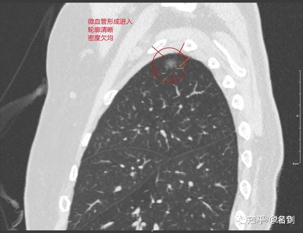 病灶密度不均,且胸膜牵拉明显,这样密度的磨玻璃结节,居然有显著的