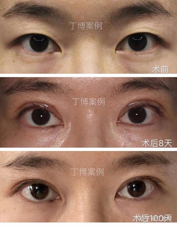 全切双眼皮(北京医院丁金萍)系列案例四十四