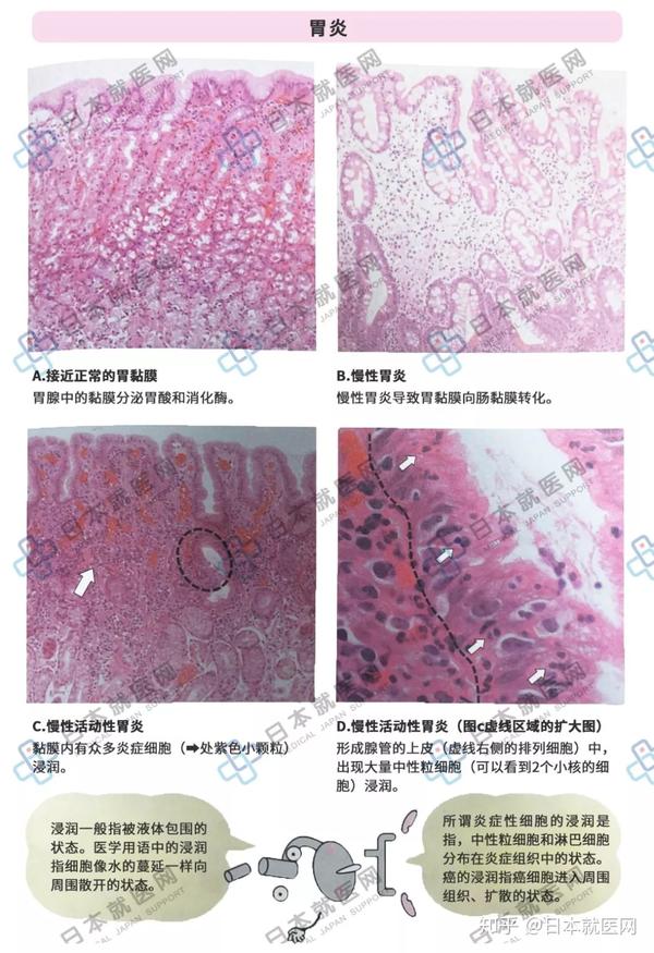 炎症解读2 | 急性与慢性炎症