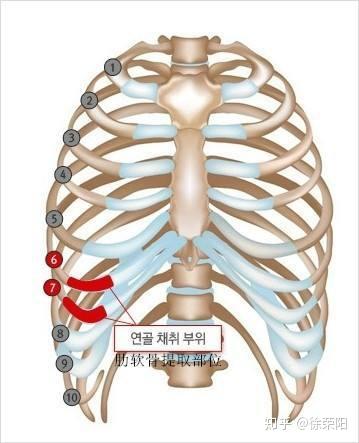 钙化的肋软骨还能做鼻综合整形