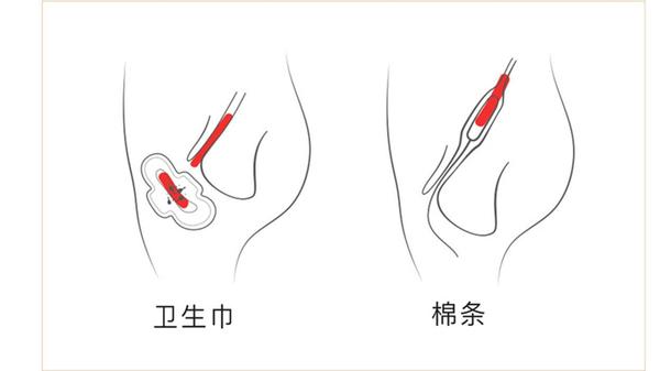 女性卫生棉条用不好容易患妇科病