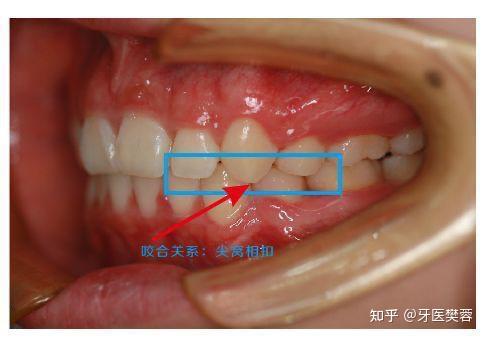 牙齿什么时候做矫正最合适