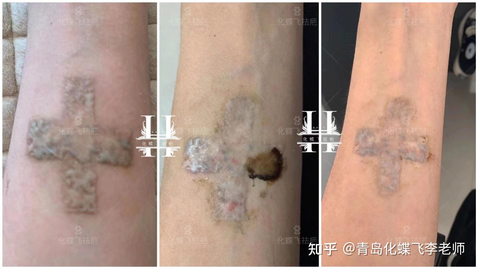 河北廊坊洗纹身增生疤痕修复