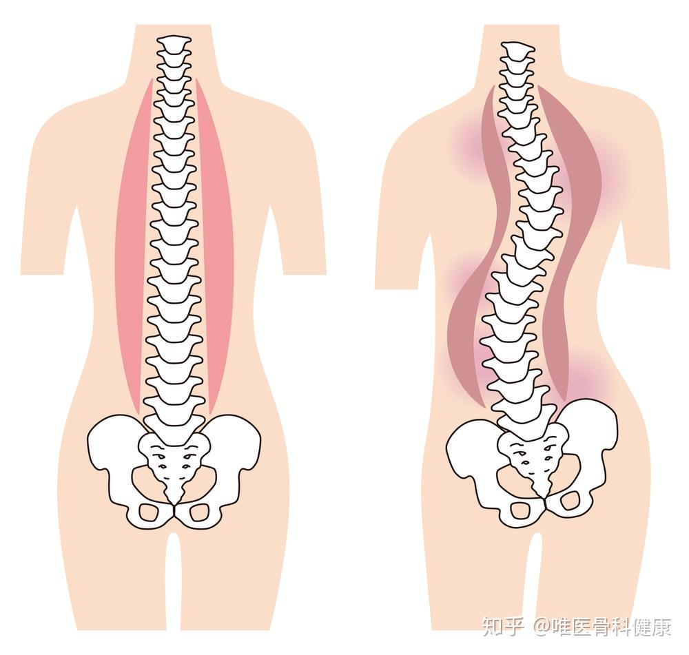 青少年特发性脊柱侧凸并没有生命危险,大多数的畸形不会引起严重的