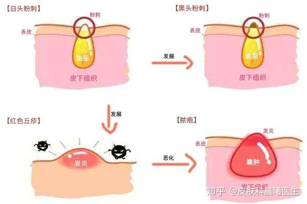 我们常说的皮肤出油实际上是皮脂分泌,当皮脂腺适当分泌油脂时,它是