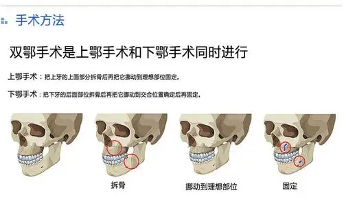 凸嘴手术正颌手术双鄂手术有什么不同颌面手术到底能解决什么问题广州