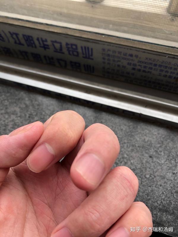 我们如何判断自己的是不是灰指甲以及目前治疗灰指甲方法有哪些?