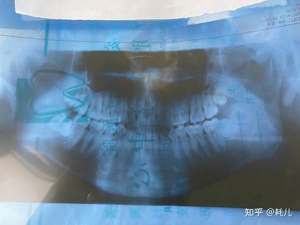 拔智齿(横向阻生牙)记录