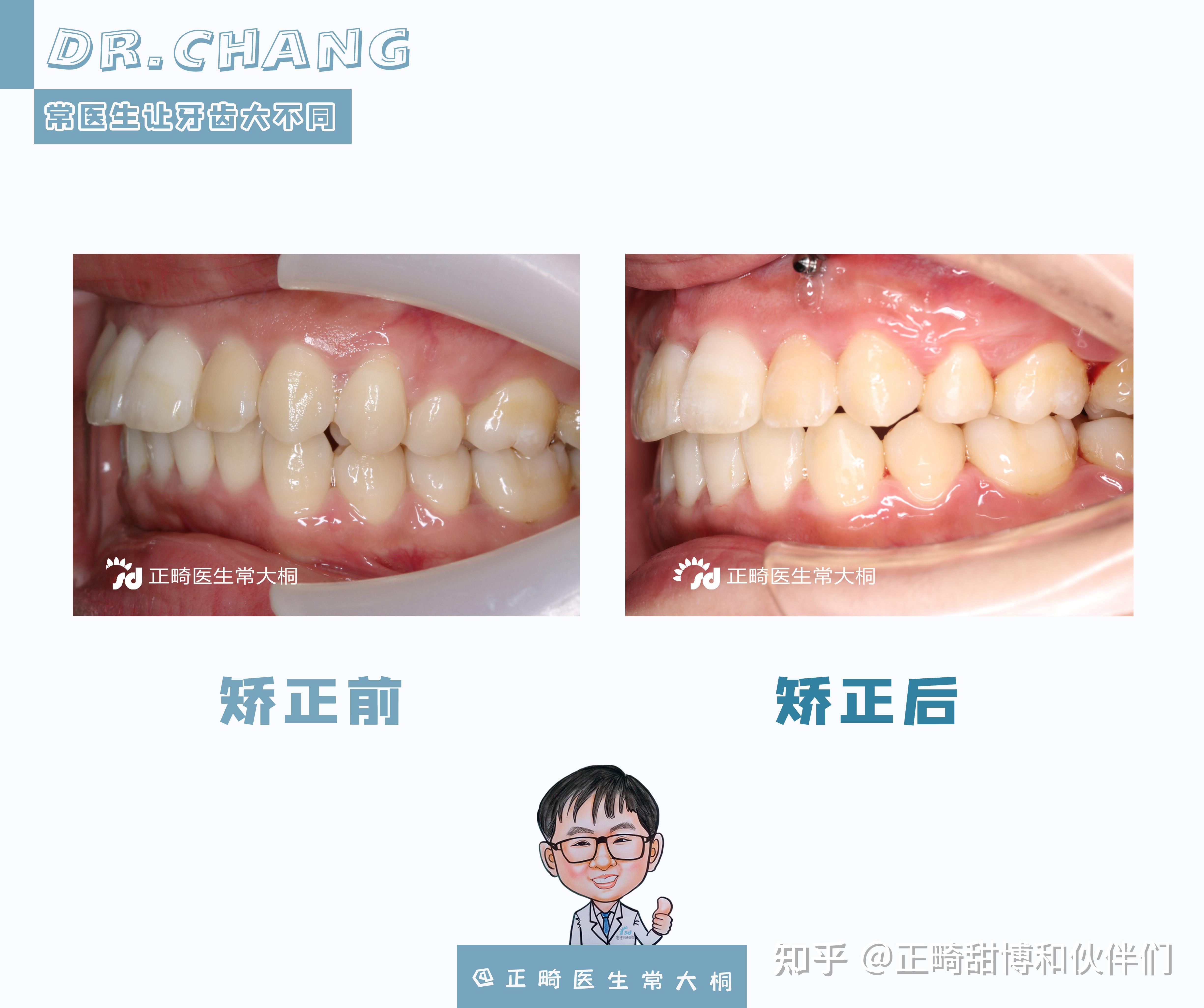 郑州牙齿矫正骨性前突二次矫正案例