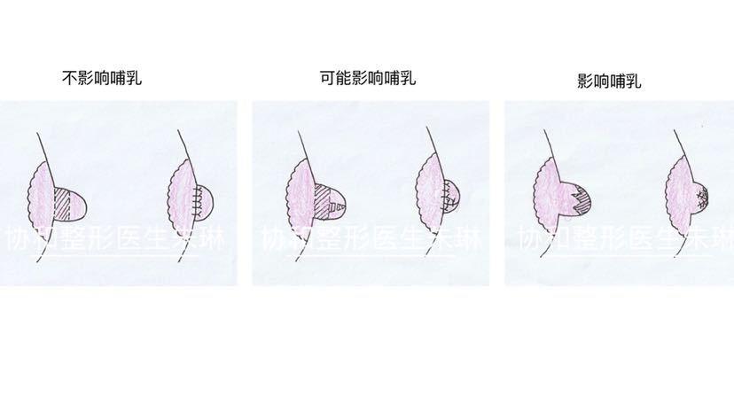 关于乳头缩小手术你想知道的都在这里