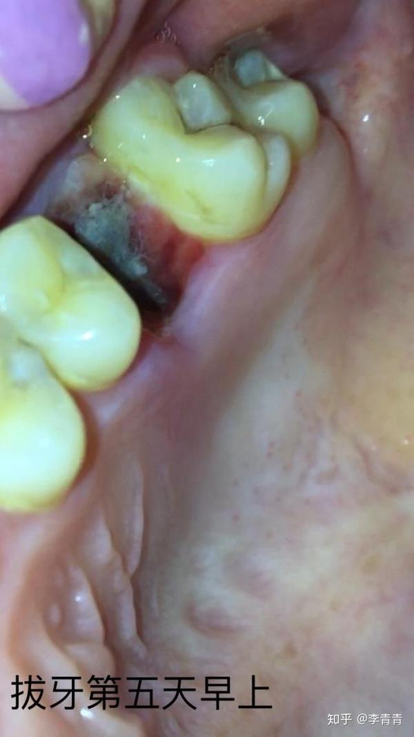 拔智齿后牙洞多久能愈合?