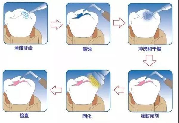 局部涂氟是由口腔专业人员将高浓度氟化物涂布在牙齿表面,具有良好的