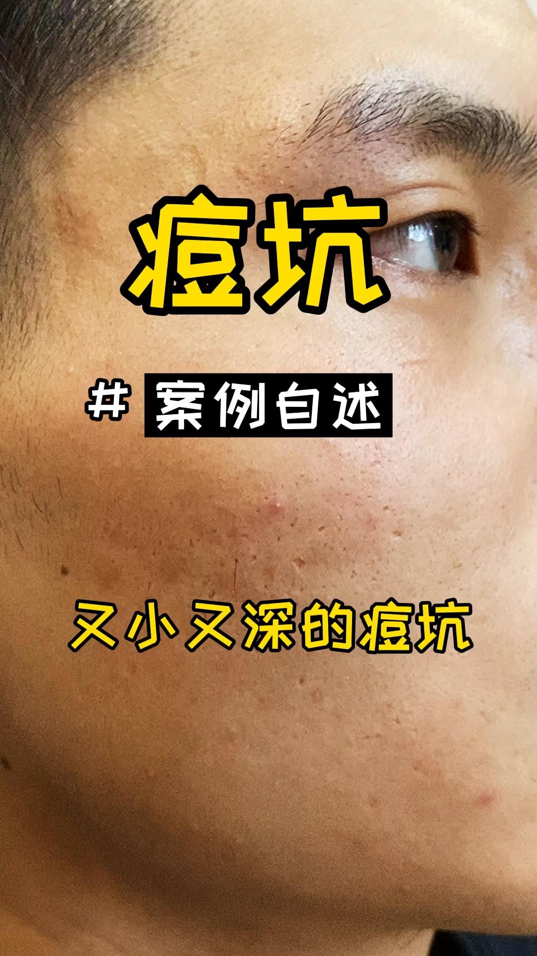 严重的碾压型痘坑,做了3次激光后的效果实录