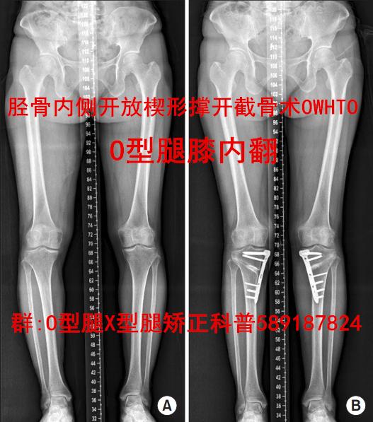 腿型矫正 术前与术后 x光对比 膝内翻o型腿-胫骨高位截骨术hto 膝外翻