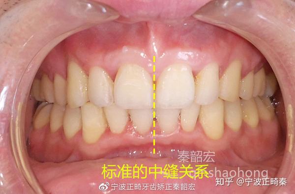 中线不齐原因:牙齿两侧用力不平衡或闭隙不一致都有可能导致中线偏移.