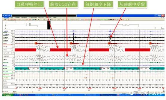 多导联睡眠呼吸监测psg解读