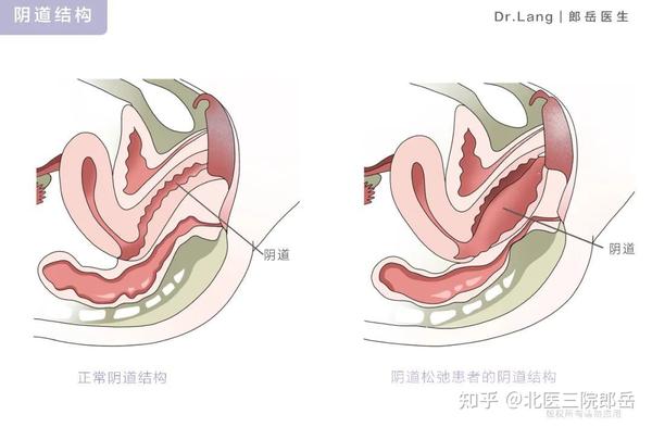 缩阴效果好吗有哪些风险