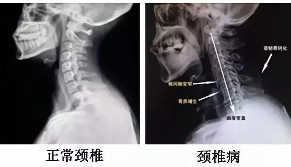 压头试验 x-ray 颈椎间盘突出 颈椎病,颈椎后纵韧带钙化症 颈椎管狭窄