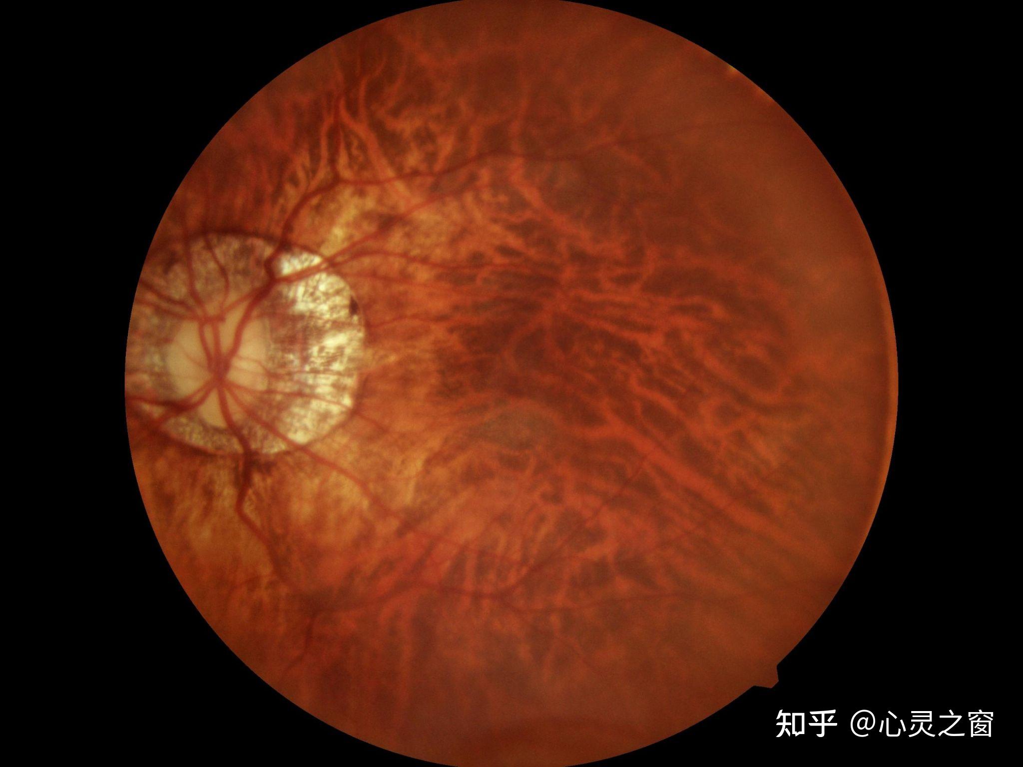 度数约增加250-300度),且眼底视网膜呈豹纹状眼底改变和弥漫性萎缩