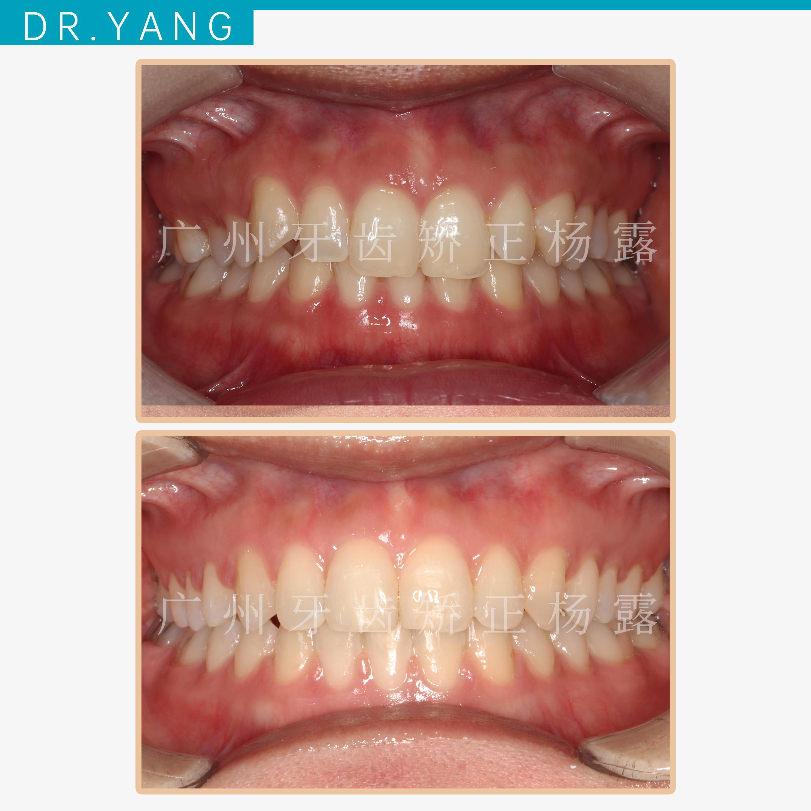 广州整牙缺失牙前牙内扣14个月时间实现笑容质变